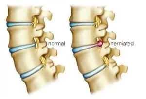 herinated disk